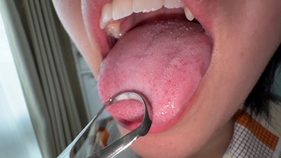 【個人撮影】加護まりの舌ブラシで「汚舌苔」採取